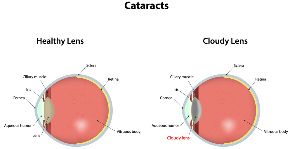 Illustration of eye cataracts