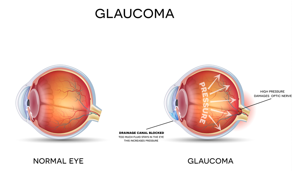 Glaucoma illustration